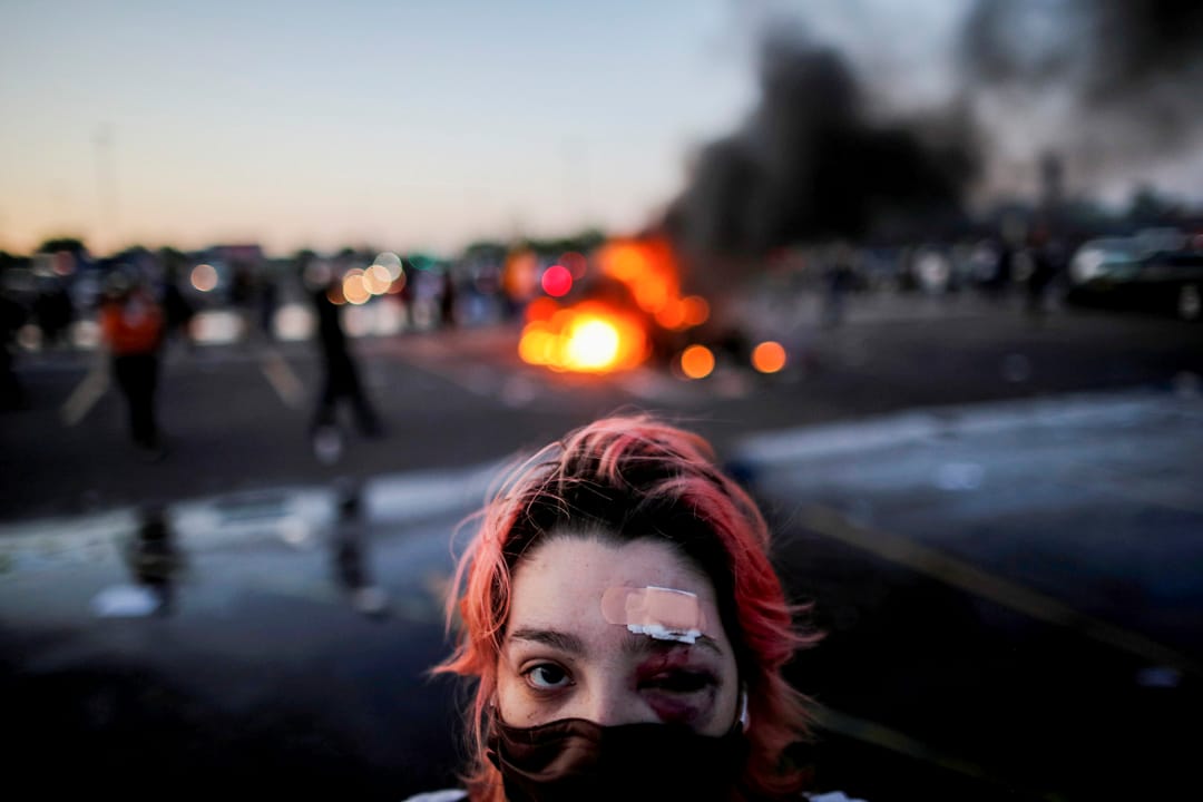 2020年5月28日美國明尼蘇達州阿波利斯市，一名示威者眼部被橡膠子彈擊傷。